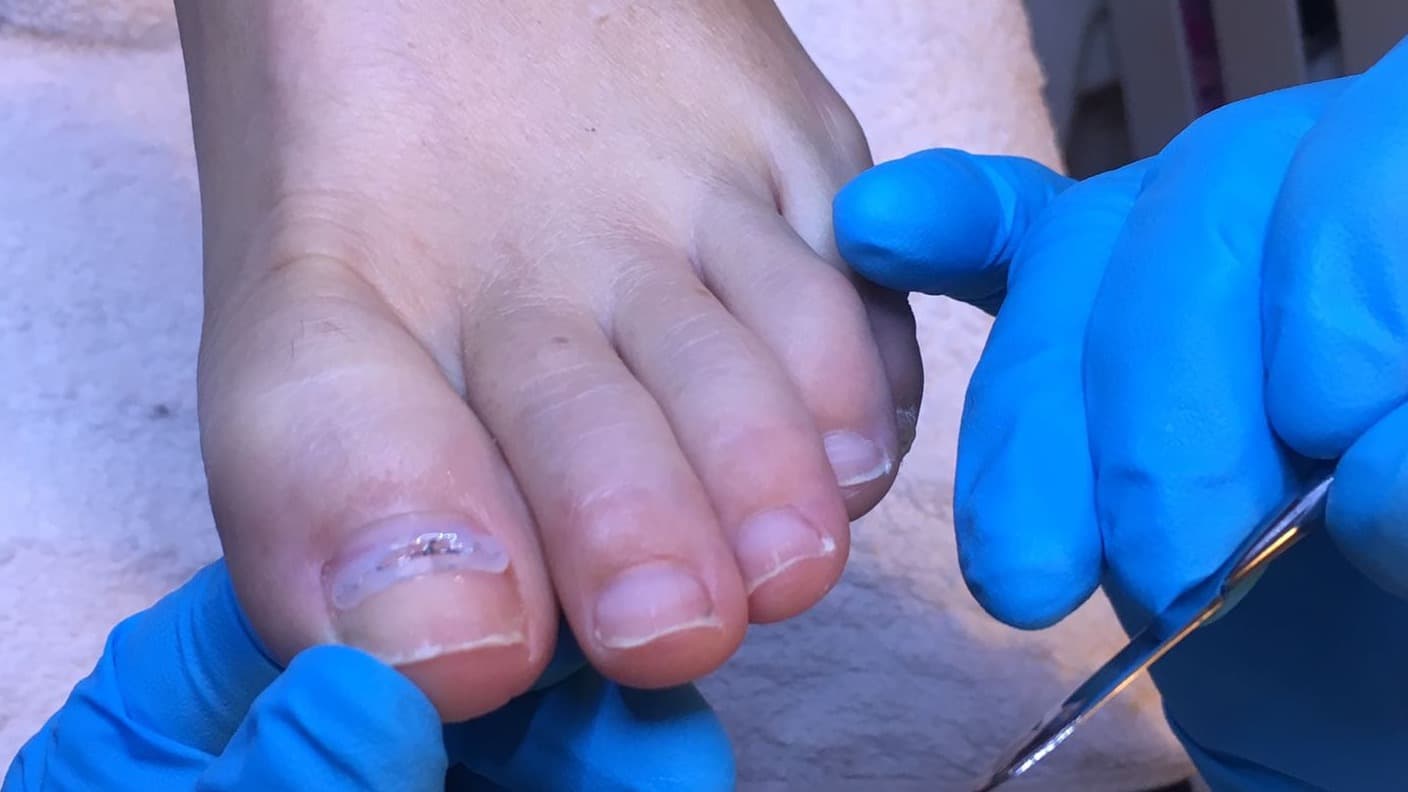 faaca722-dd34-44ea-a4d1-b2b7f59710dd foto met nagelbeugel.JPG